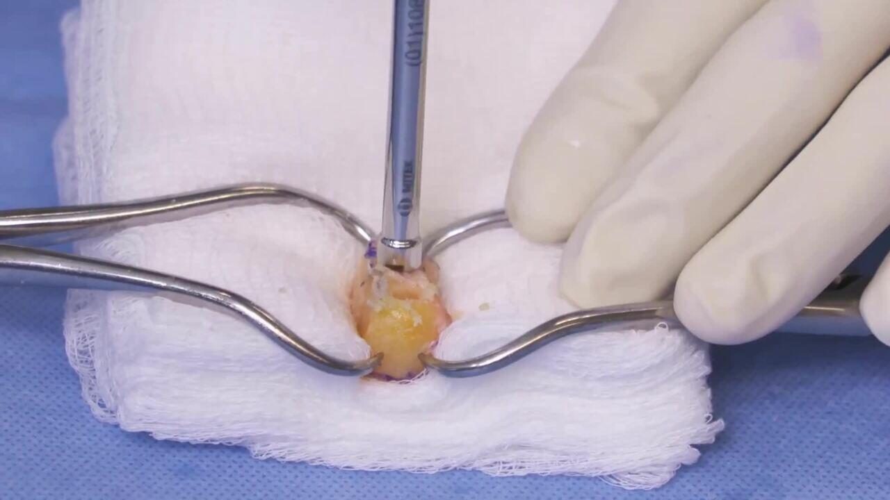 CHIA PERCPASSER™ Suture Passer | Products | DePuy Synthes